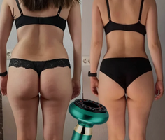 SilvaSculpt™ | Si farvel til cellulitter og hei til din beste hud noensinne