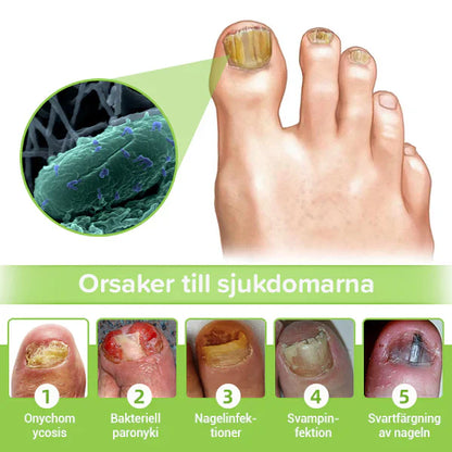 NailBeam™️ | Fjern neglesopp innen 7 dager!